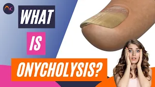 What is Onycholysis Nail lifting and Separation Explained