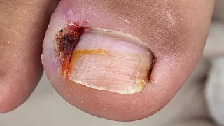 Ele sofreu muito antes do procedimento #nails #satisfying