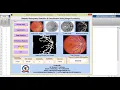 Matlab Code for Diabetic Retinopathy Detection Using Image Processing