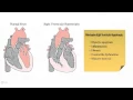 The Right Ventricle in Pulmonary Hypertension