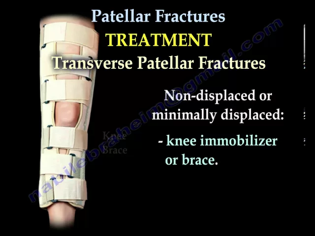 Patellar Fractures - Everything You Need To Know - Dr. Nabil Ebraheim