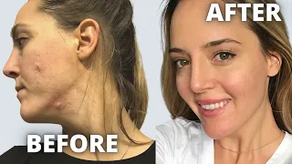 How I Cured Hormonal Cystic Acne After 10 years Naturally Long Term Clear Skin Glowy Skin