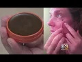 Doctors Warn Against Unproven Skin Treatment Called Black Salve