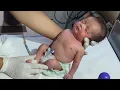 Spacial baby with Achondroplasia Complete Nursing Assessment Specialized Newborn Care