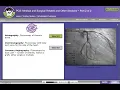 HCGTV - Heart Cath Coronary Angiography and Ventriculography What Gets Coded
