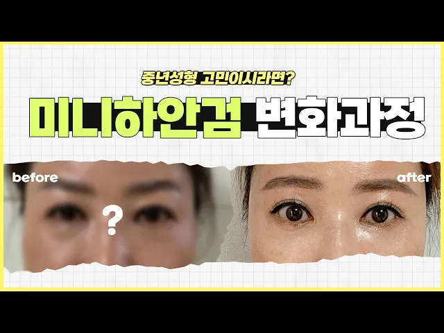 미니하안검 망설이고 계셨다면 변화과정 확인하세요!