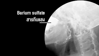 การกลืนแป้งแบเรียมซัลเฟตปลอดภัยหรือไม่