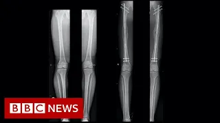 Download Leg-lengthening: The people having surgery to be a bit taller - BBC News MP3