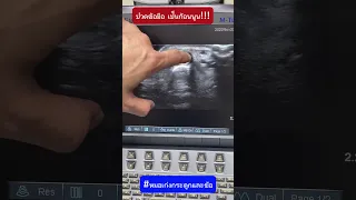  ทำไมคนไข้ที่ปวดข้อมือเรื้อรังถึงมีก้อนนูนที่ข้อมือ และก้อนนั้นคืออะไร 