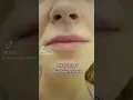 Download Lagu Lip filler 1ml transformation #lipfiller #lipfillers #lipfillerbeforeandafter