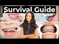 How To Prepare What To Expect With BRACES