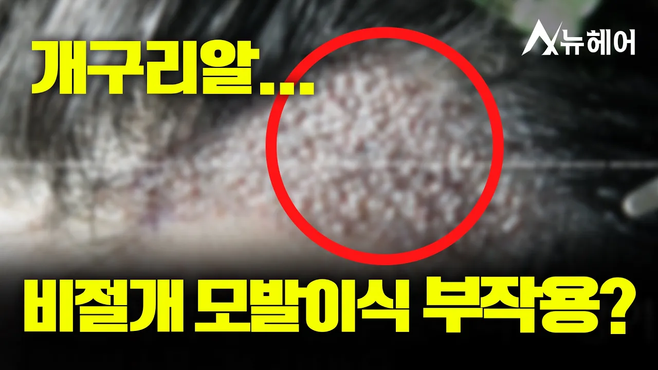 개구리알, 나만 모르는 비절개 모발이식 부작용?ㅣ뉴헤어