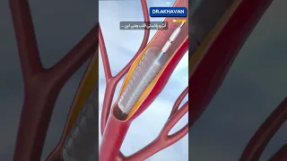 آنژیو قلبی به چه صورت انجام میشه    روش تشخیص گرفتگی عروق دندنها