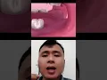 Download Lagu saat beranjak dewasa gigi bungsu kalian akan tumbuh harus dicabut ya guys 😱😱😭😭 || #SHORTS