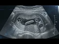 Fake kids Ultrasound Scan Warms Stomach scan