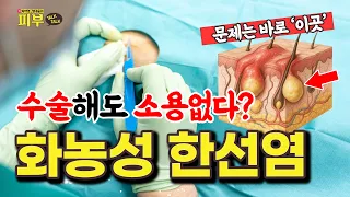 화농성 한선염은 왜 자꾸 재발할까? 뿌리까지 뽑아내는 한의학적 치료법 - 정대웅, 이신기의 피부 톡톡 #243