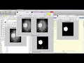 Brain Tumor Detection and Classification Using Matlab Brain Tumor Prediction Analysis