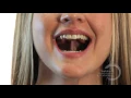 Download Lagu Myofunctional Therapy | Tongue Click and Smile
