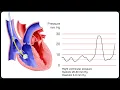 Insertion of a Pulmonary Artery Swan-Ganz Catheter