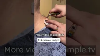 Never Squeeze Acne With Your Hands 