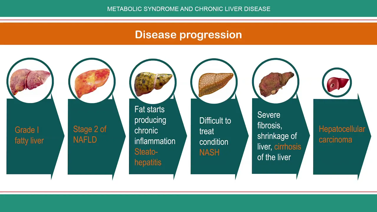 Metabolic Syndrome and Chronic Liver Disease