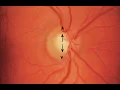 Normal Optic Disc Appearance