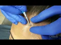How to Remove a Blackhead Correctly