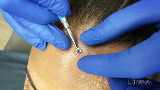 How to Remove a Blackhead Correctly