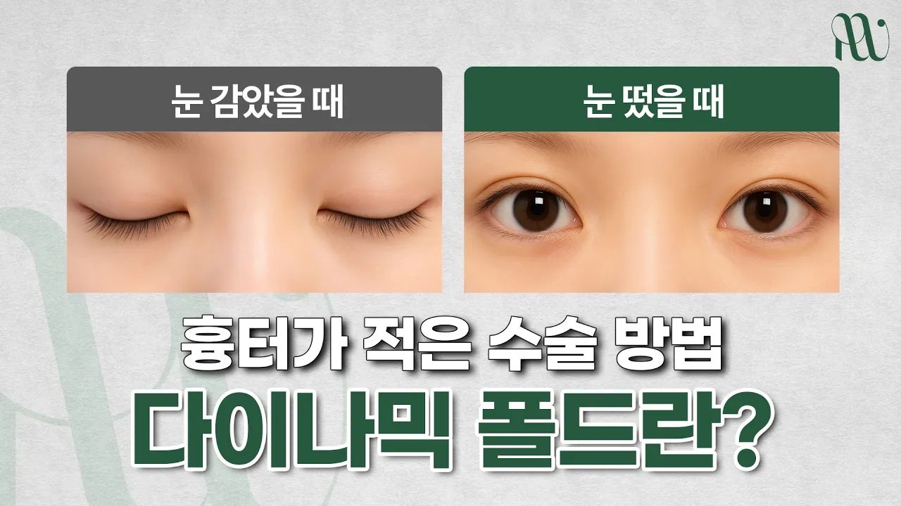 흉터가 적은 수술 방법, 다이나믹 폴드 수술방법이란?