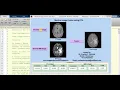 Matlab Project on Medical Image fusion using PCA Full Source Code