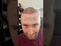 Hair Transplant Journey 13 Days of SHOCKING Changes
