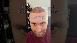 Hair Transplant Journey 13 Days of SHOCKING Changes