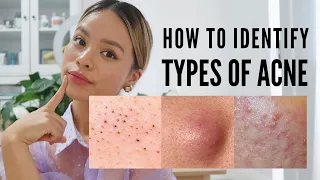 How to treat EVERY type of acne With Pictures