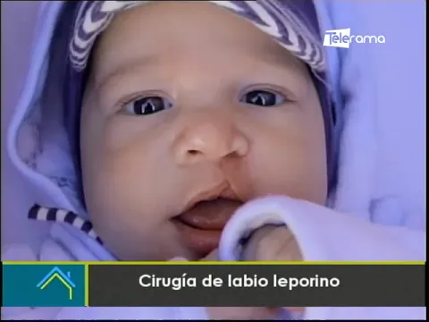 Estética al Día: Cirugía de labio leporino