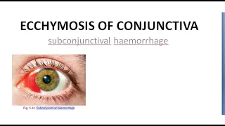 Download Ophthalmology Ecchymosis of Conjunctiva SubConjunctival Hemorrhage Blood red eye MP3