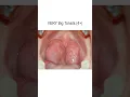 Download Lagu Tonsils From None to Very Big (4+) #shorts @fauquierent