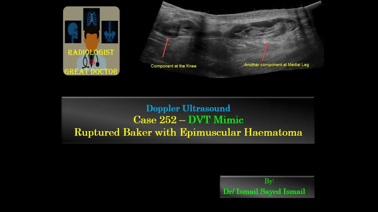 Ultrasound Case 252 - DVT mimicker (Ruptured Baker Cyst)