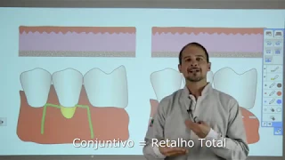 (Ep 08) Diferença entre Enxerto Conjuntivo e Enxerto Gengival Livre