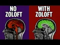 Top 5 Things You Need To Know About Zoloft