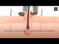 What is an FUE hair transplant