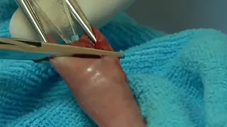 الطهور اوا الختان بطريقة الحلقه البلاستيكيه05380819781 