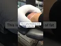 Download Lagu How we freeze fat with CoolSculpting #shorts