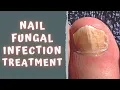 HOW TO TREAT FUNGAL NAIL INFECTION - TINEA UNGUIUM ONYCHOMYCOSIS