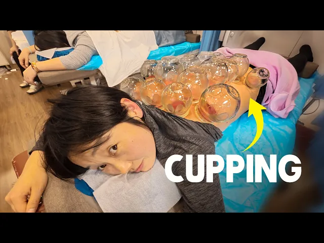 Hangzhou Traditional Chinese Medicine: Acupuncture & Cupping Efficacy Does Chinese Medicine Really Help? 🇨🇳