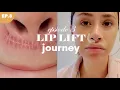 LIP LIFT SURGERY Episode 3 - This scar is not healing right