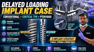 Delayed Loading Implant Case | Conventional + Cortical TPR
