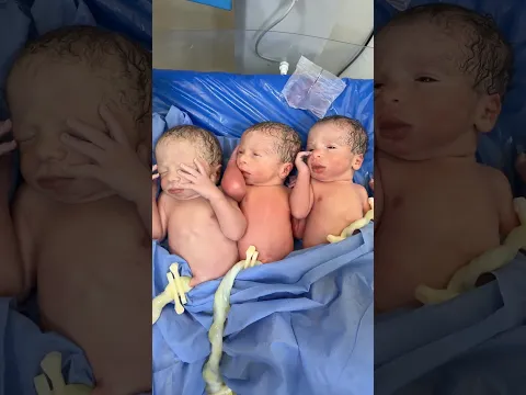 Triplets babies cord clamping