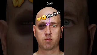 كيف تشفي اصابه العين         دندنها