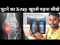 Learn to read X-rays online Meaning of X-rays Knee X-ray interpretation Knee Osteoarthritis X