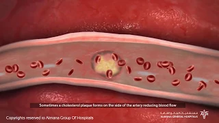 كيف تحدث الجلطة القلبية او النوبة القلبية و ما هي اسبابها 